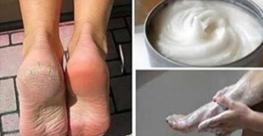 Imate razpokane pete? S tem čudeženim pripravkom, ki si ga lahko pripravite doma, bodo vaša stopala spet kot “nova”…